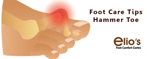 Hammer Toe Treatments